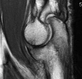 MRI Ulna Trochlea OA